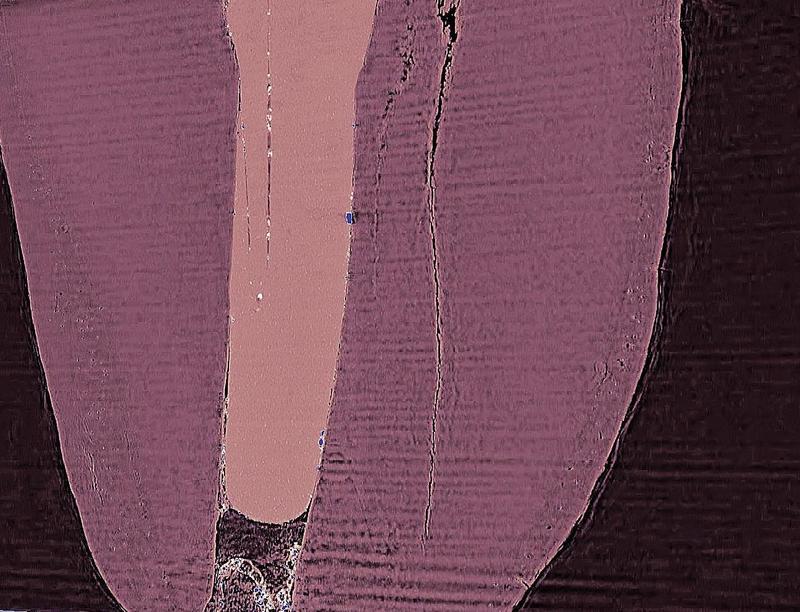 An BESSY II konnten die Forscher mit Hilfe der μCT Details an der Grenze zwischen Füllung und Zahnwurzel und Mikrorisse in der Zahnsubstanz genau vermessen und untersuchen.