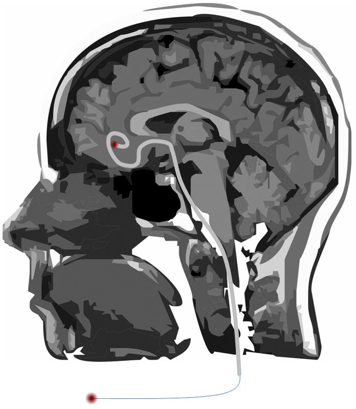 Schematische Darstellung des Einsatzes der Fasertechnologie FiberLab in der Medizin als Hirnkatheter.