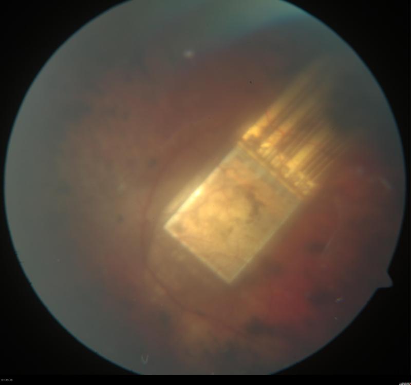 Netzhaut-Chip unter der Netzhaut des Patienten 