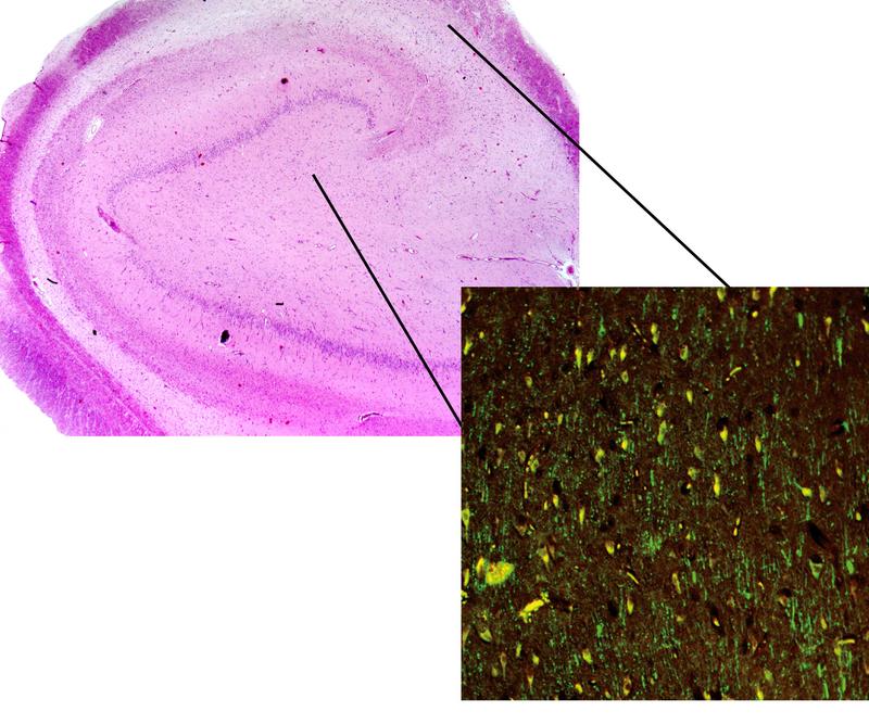 Operationspräparat eines gegen Antiepileptika resistenten Patienten mit Schläfenlappenepilepsie, das einen einzigartigen Zugang zu menschlichem Gehirngewebe darstellt (oben links). 