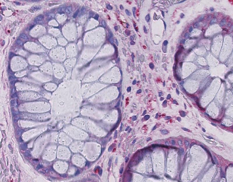 Dünndarmzotten von Patienten mit GHVD: Unter dem Mikroskop sind in den Zwischenräumen viele kleine rote Pünktchen zu sehen. Das sind Immunzellen, in denen das  Interleukin-1-beta aktiviert ist.
