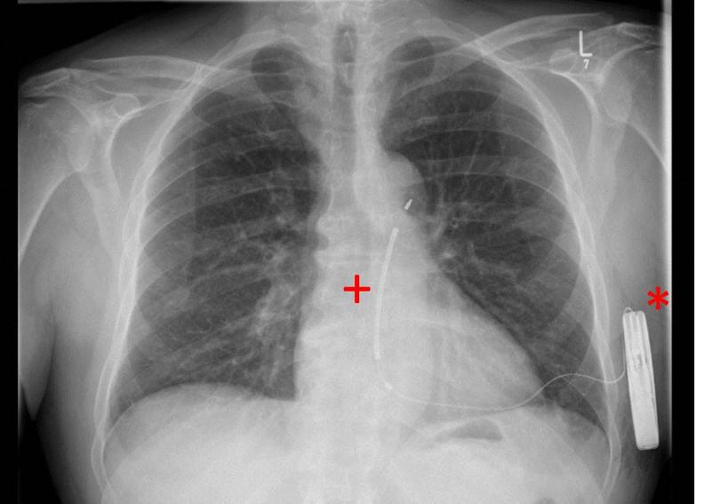 Röntgenaufnahme vom ersten transplantierten Defibrillator der neuesten Generation