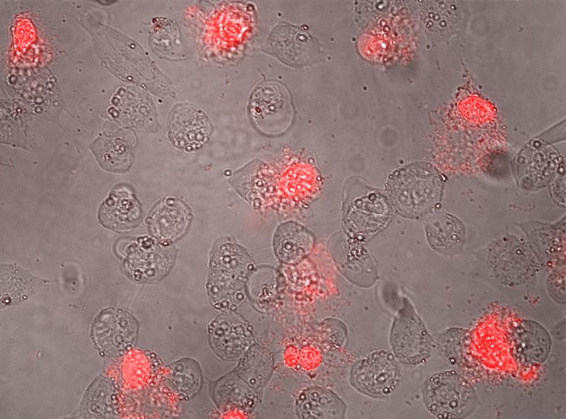 Mit dem Antitumor-Peptid behandelte Hautkrebszellen: Auf Bläschenbildung folgen starke Membranschädigungen und Zelltod (rot).