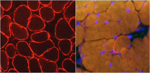 Links: Muskeln einer gesunden Maus. Rot gefärbt ist das Muskelstrukturprotein Dystrophin. Rechts: Duchenne-Maus, bei der das wichtige Protein (rot) kaum vorhanden ist. Blau markiert sind Zellkerne.