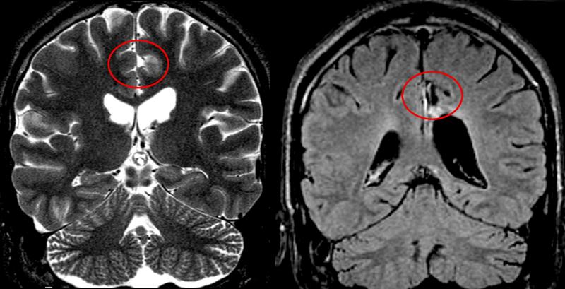 Magnetresonanz-Aufnahmen eines Patienten mit fokaler kortikaler Dysplasie vor (links) und nach der Operation. Blick von hinten auf das Gehirn.