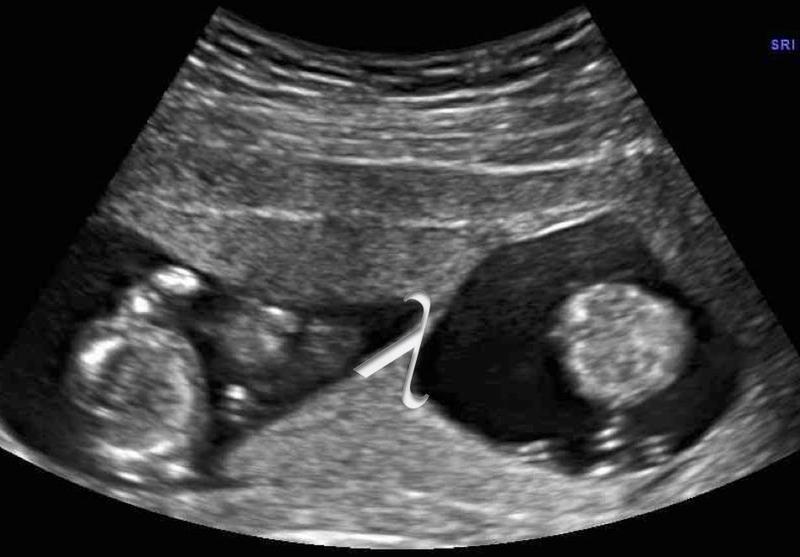 Zwillinge im Ultraschall: am keilförmigen Ausläufer der Fruchthülle, dem Lambda-Zeichen, können Ärzte eine „dichoriotische“ Zwillingsschwangerschaft sicher erkennen. Jedes Baby mit eigener Plazenta.