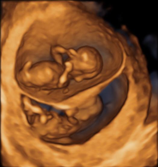 Auch im 3D-Ultraschall können Pränatalmediziner „dichoriotische“ Zwillinge in der Frühschwangerschaft gut erkennen. Hier in der 13ten Schwangerschaftswoche.
