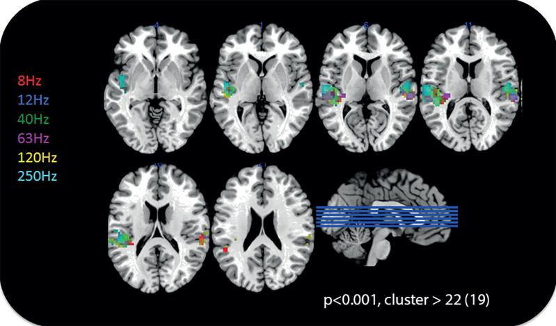 Aktivität im Gehirn im Gebiet des auditiven Cortex bei Stimulation durch niederfrequenten Schall und Infraschall 