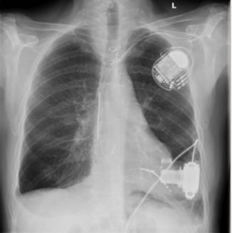 Röntgen-Thoraxaufnahme eines Patienten mit Herzschrittmacher und LVAD (Heartware)