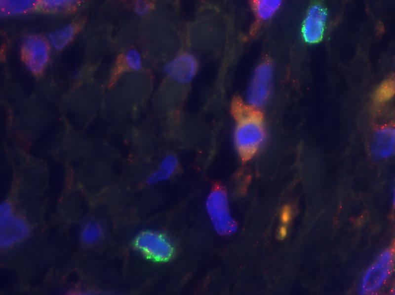 Lebertumorzelle mit den tumorbekämpfenden Immunzellen IL 33 und CD8+.
