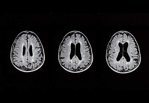 MS-Läsionen im MRI 