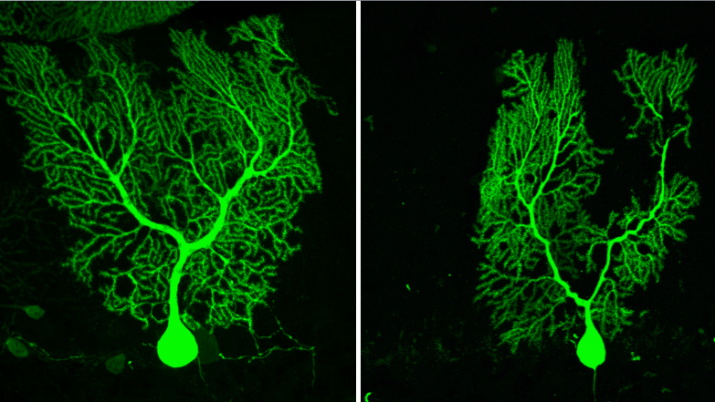 Left: A healthy Purkinje cell displaying an elaborate dendritic arbor covered in spines. Right:  A Purkinje cell afflicted with ataxia, showing classical hallmarks of  degeneration