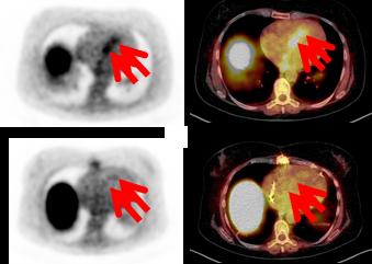 Entzündungsprozesse am Herzens mittels nuklearmedizinischer Verfahren dargestellt (DOTATOC-PET/CT). Die Pfeile zeigen auf die Entzündungsaktivität in der Herzscheidewand (Pfeile).