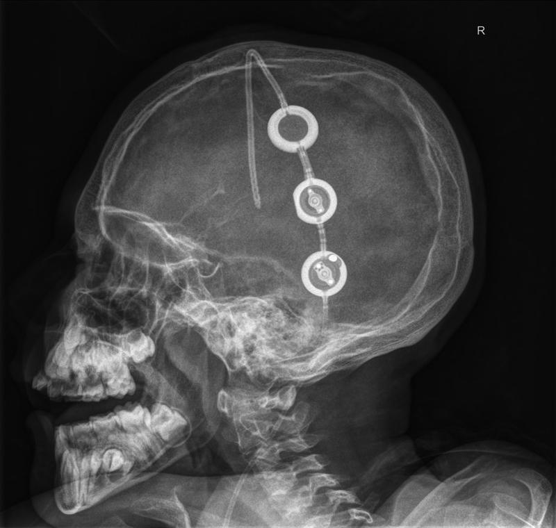Seitliche Röntgenaufnahme des Schädels eines Patienten, bei dem ein Shuntsystem implantiert worden ist.
