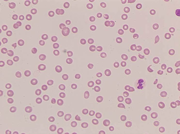 Blood smear of patient with TTP under the microscope.