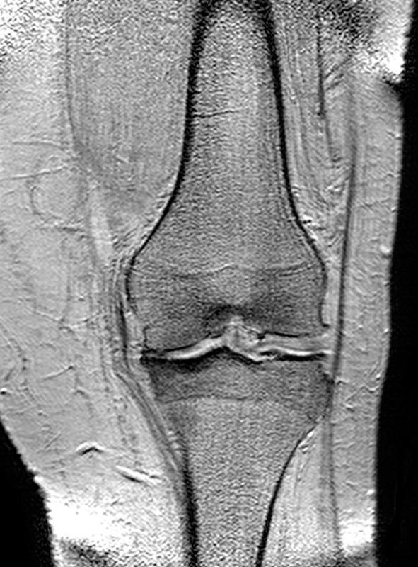 Magnetresonanztomographie eines arthrotischen Kniegelenkes. Zu sehen ist der Verschleiss der Knorpelschicht im linken Bereich des Bildes. 