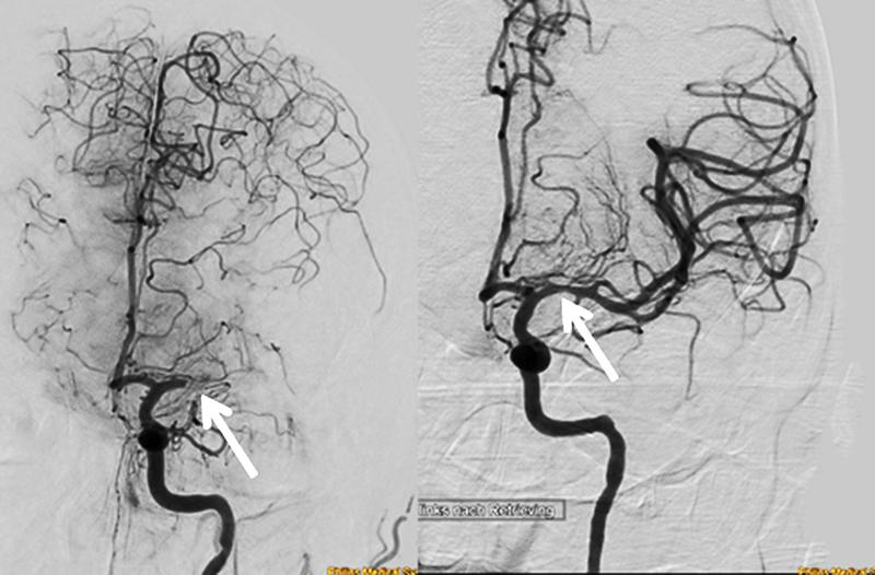 Bild: links: Durch ein Blutgerinnsel (Pfeil) wird ein großer Bereich des Gehirns von der Sauerstoffversorgung abgeschnitten. Rechts: Wiedereröffnetes Gefäß nach Entfernen des Gerinnsels mittels Stent