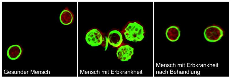 Gesunde Blutplättchen besitzen organisiertes Aktin-Zellskelett (rot), umgeben von Mikrotubuli (grün). Bei Patienten mit TRPM7 Kanal Defekt ist dies geschädigt,kann aber mit Mg2+ normalisert werden.