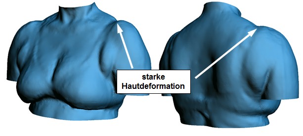 Hautdeformation im Schulterbereich am Beispiel der Größe 80 C, Altersgruppe zwischen 60 und 70 Jahren.