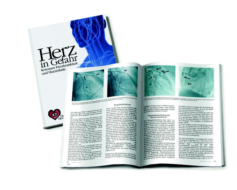 Mehr Infos zur Fragestellung "Stent oder Bypass?" bietet der Experten-Ratgeber "Herz in Gefahr" der Deutschen Herzstiftung. 