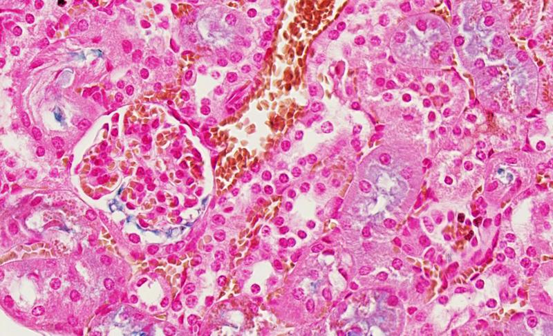Können Monozyten nicht in die Leber einwandern und sich zu Eisen-verwertenden Zellen entwickeln, lagert sich giftiges Eisen in Organen wie der Niere ab. (Eisen frei: blau,Eisen-Protein-Komplex:braun)