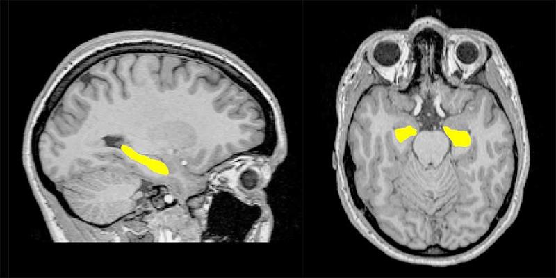 Lage das Hippokamus im menschlichen Gehirn: sagittale und axiale Ansicht (von links nach rechts) des Hippokampus (in gelb) in einer Magnetresonanztomographie-Aufnahme.