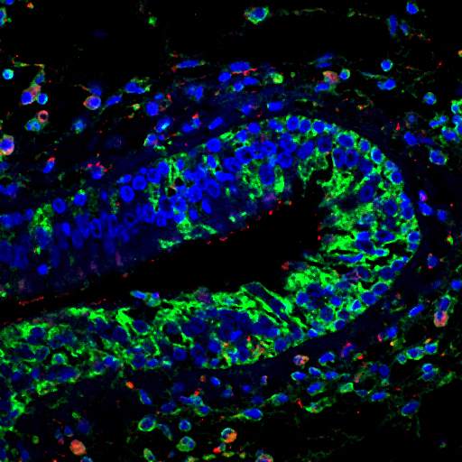 Immunhistologische Färbung von Gewebe eines Nasenpolypen: In Epithelzellen und Entzündungszellen (Zellkerne in blau) sind Komponenten der Leukotrien-Kaskade aktiv (grün bzw. rot).