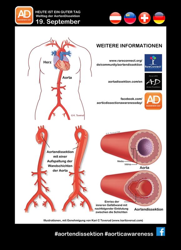 Aortendissektion Grafik