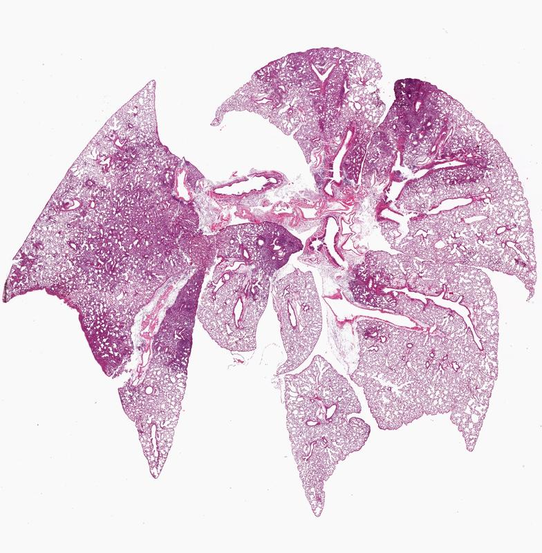 Lungenschnitt nach Ko-Infektion durch Influenza A-Viren und Pneumokokken. Die entzündeten Areale der Lunge mit vielen eingewanderten Immunzellen sind als dunkle Verfärbungen zu erkennen.