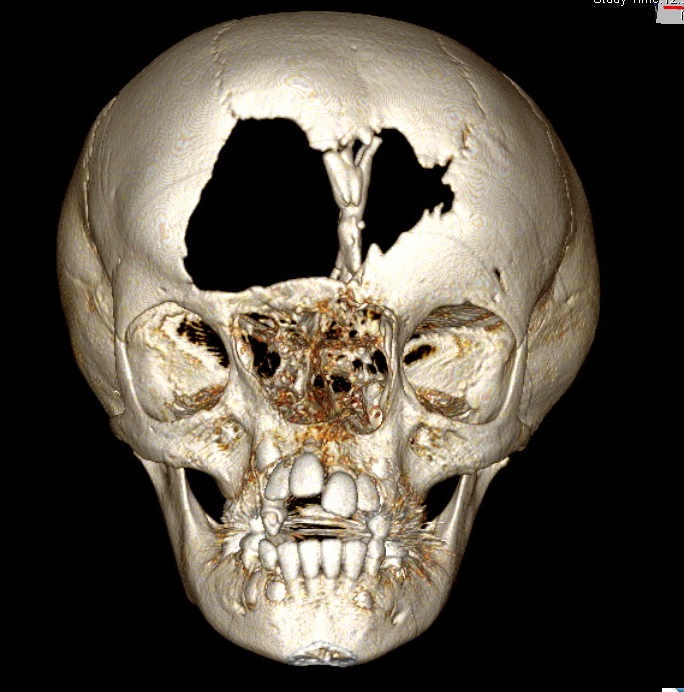 3D-Computertomographie eines Patienten mit schwerer kraniofazialer Fehlbildung