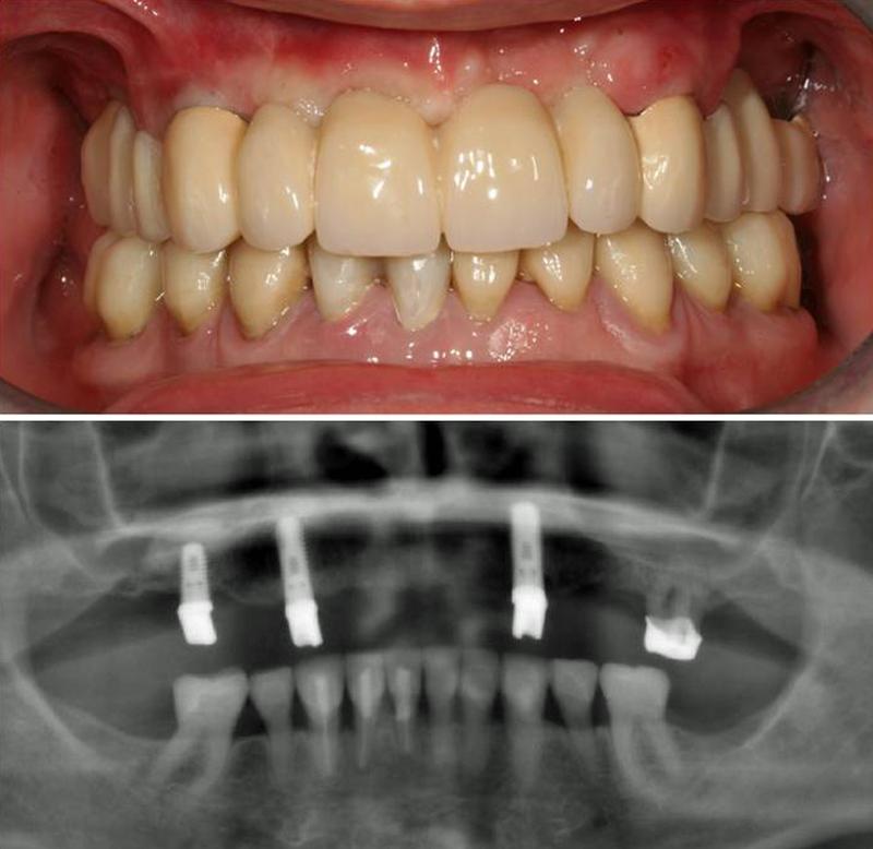 Beispiel für einen von Prof. Richter erstellten Zahnersatz: Eine herausnehmbare Brücke, die auf drei Implantaten und einem eigenen Zahn ruht. Das Kontrollbild entstand ca. 7 Jahre nach der Therapie.