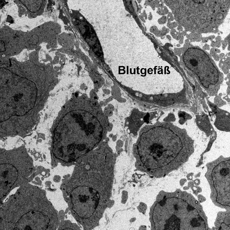 Elektronenmikroskopische Aufnahme der Interaktion von Lymphomzellen mit Epithelzellen der Blutgefäße. 