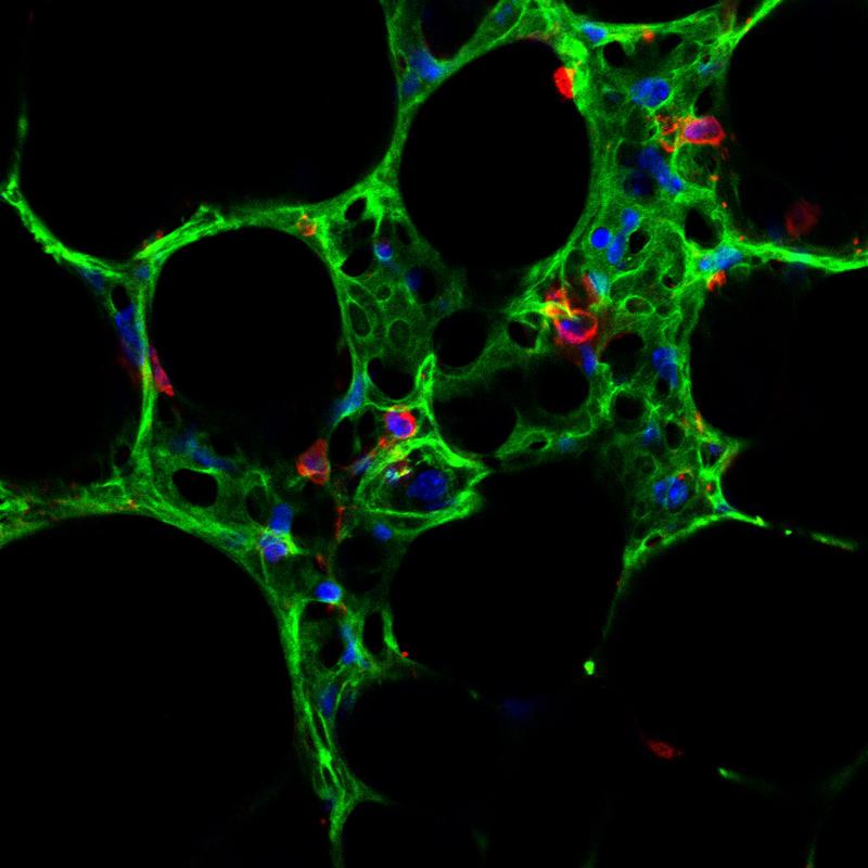 Das Molekül Wnt5a ist verantwortlich dafür, dass bei COPD Patienten Strukturen der Lunge (hier dargestellt das Lungenbläschen-Epithel in Grün und Immunzellen in rot) nicht mehr heilen.