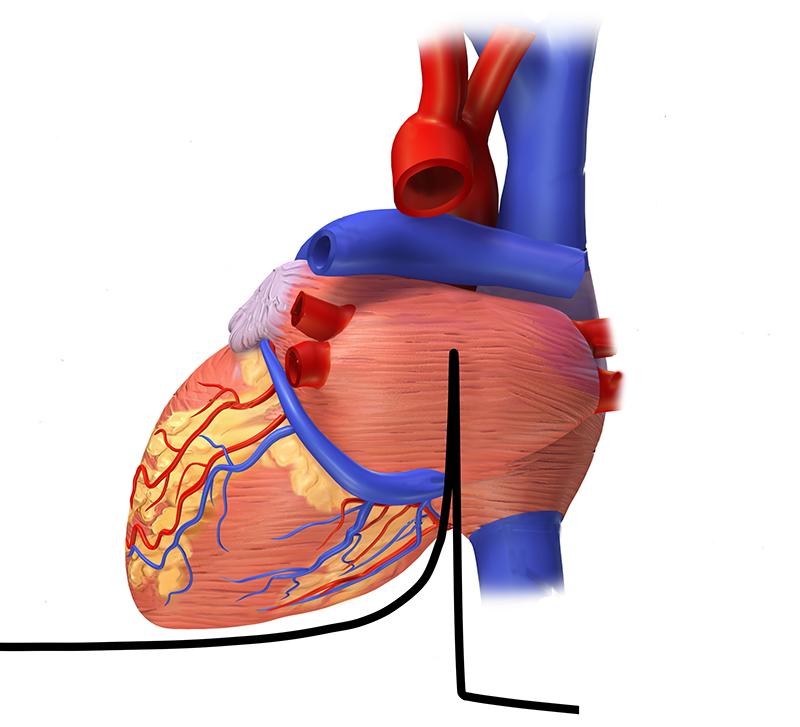 The treatment of cardiac arrhythmia with ions is studied at GSI. In the area of the Bragg peak (black) ions deposit their energy and the t