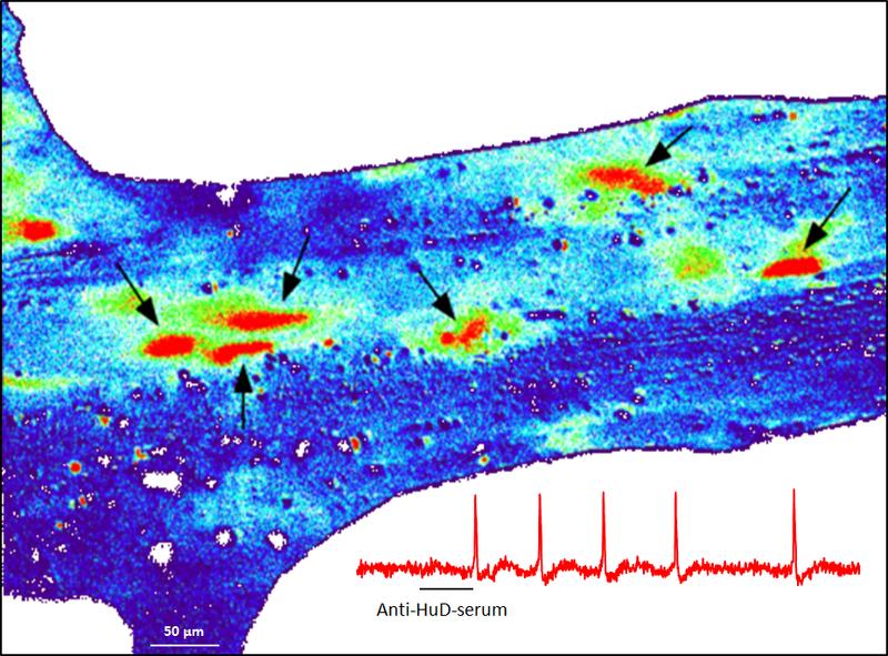 A Ganglion in the human intestine, which shows nerval activity after giving the anti-HuD-serum. The activity is red.