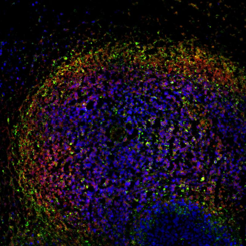 Immunfluoreszenzfärbung eines kutanes T-Zelllymphoms nach DMF-Behandlung *weitere Erläuterung im Textanhang