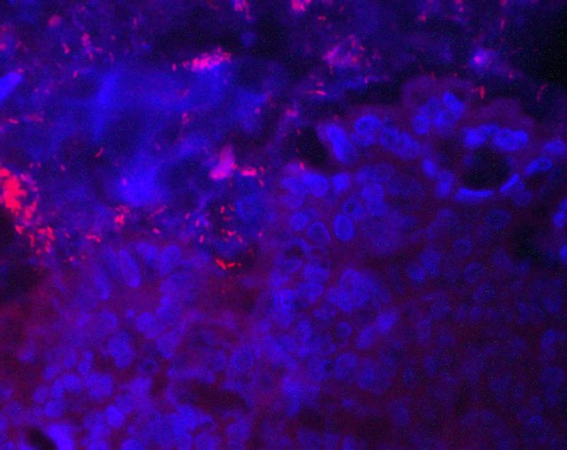 Bakterien (rot) im Bereich intestinaler Tumore (blau) 