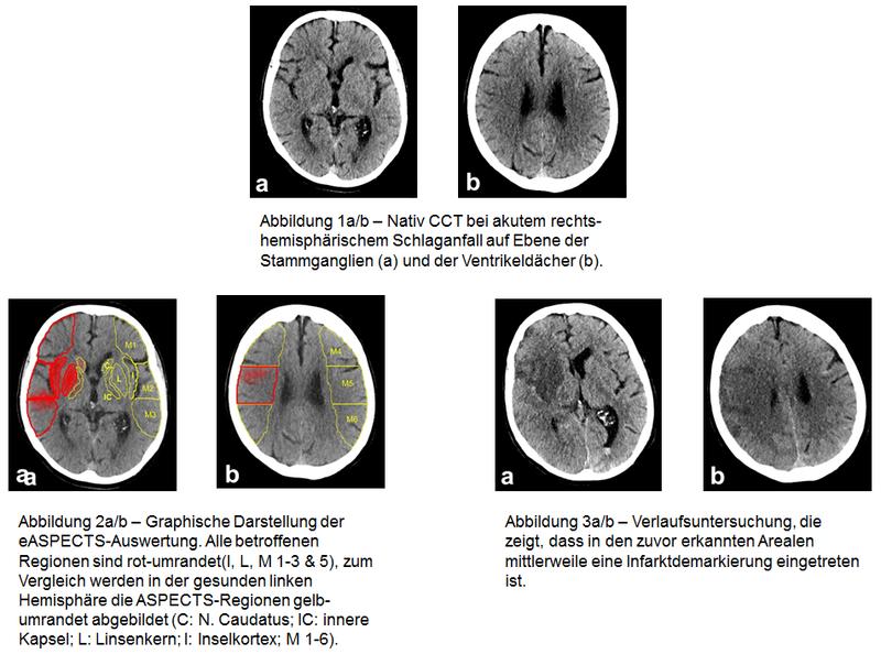  Softwaregestützte Abschätzung des Schweregrads eines Schlaganfalls anhand von CT-Bildgebung. 