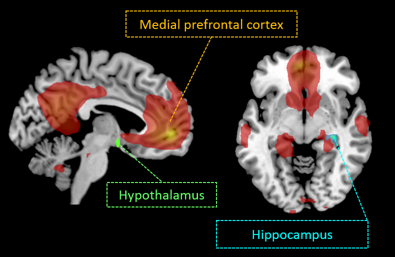 Intranasal insulin enhances functional connectivity in specific cognitive brain regions (default-mode network, DMN) as well as in the hippocampus and the hypothalamus. 