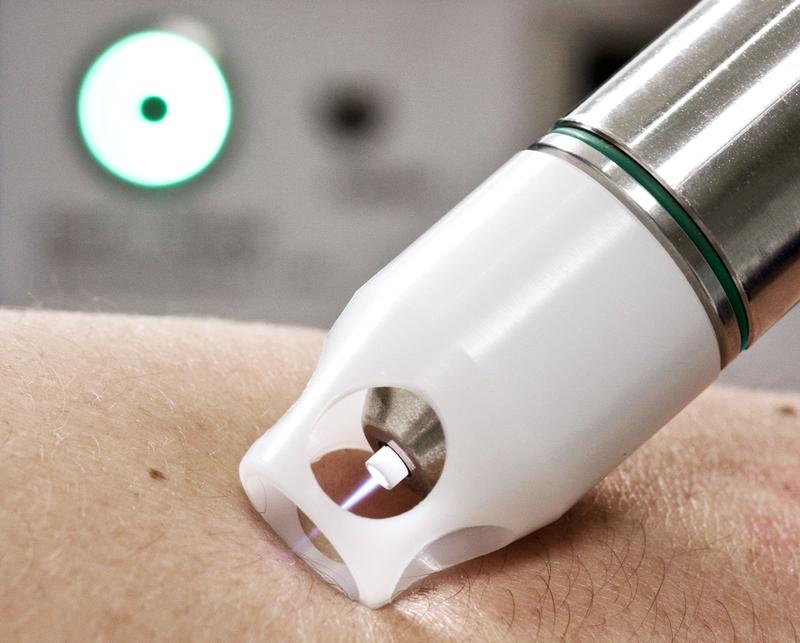 Plasmatherapie mit dem kINPen MED 