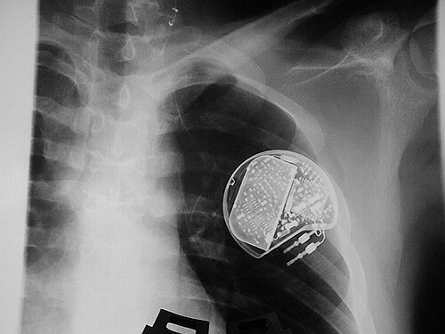 Schrittmacher für die Seele: der taschenuhrgroße Vagusnerv-Stimulator. Bilder zu dieser Pressemitteilung finden Sie unter http://www.verwaltung.uni-bonn.de/presse/Bildgalerie/vns/vns.htm