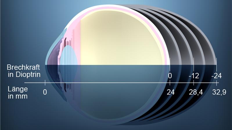 Ein zu großer Augapfel führt zu starker Kurzsichtigkeit.
