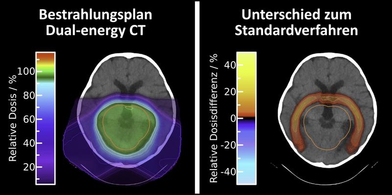 Durch die neuartige Bestrahlungsplanung auf Basis der Dual-Energy Computertomographie (links) lässt sich die Strahlendosis bei der Protonentherapie rings um den Tumor verringern (rechts).