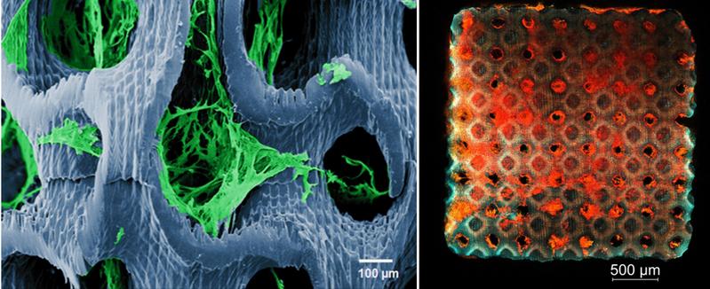 Tumorzellen auf 3D-Scaffold (links: Detail, Rasterelektronenmikroskopie, coloriert;      rechts: Übersicht, Konfokalmikroskopie)