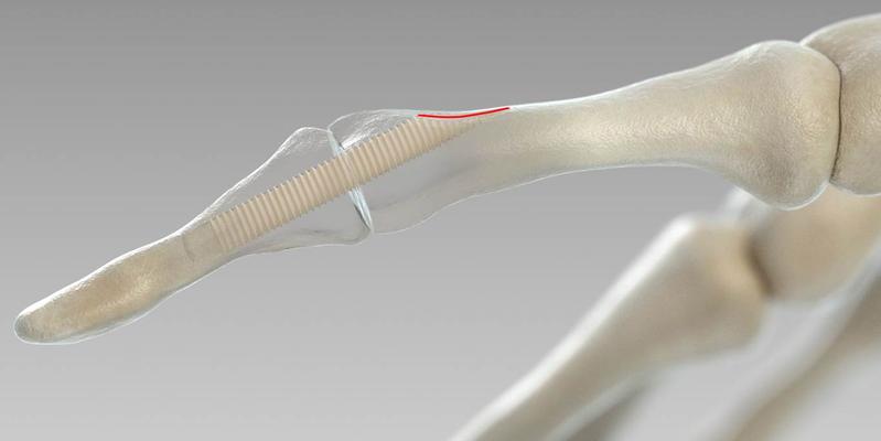  Das Spendermaterial heilt vollständig in den Knochen ein.