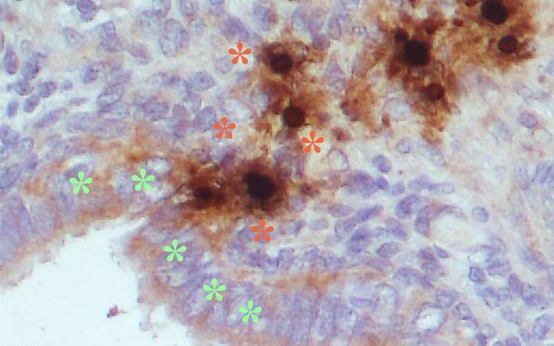 PIF (grün) moduliert die Immunzellen (rot) in der Endometriose (Mikroskopische Aufnahme)