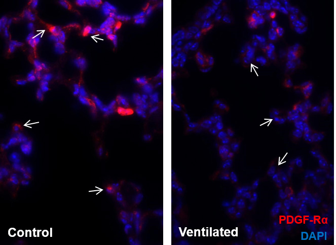 Versuchsmodell zeigt geringere Produktion von PDGF-Rα in Verbindung mit künstlicher Beatmung. PDGF-Rα positive Myofibroblasten sind in Rot, Zellkerne in Blau dargestellt.