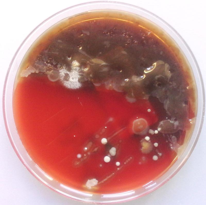 Chronische Infektionen mit dem Lungenkeim Pseudomonas – in diesem Ausstrich die braunen, schleimigen Bereiche – verändern bei Patienten mit Cystischer Fibrose das Mikrobiom in der Lunge. 