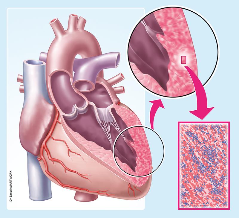 Herzmuskelentzündung – eine oft unterschätzte Erkrankung des Herzens. 