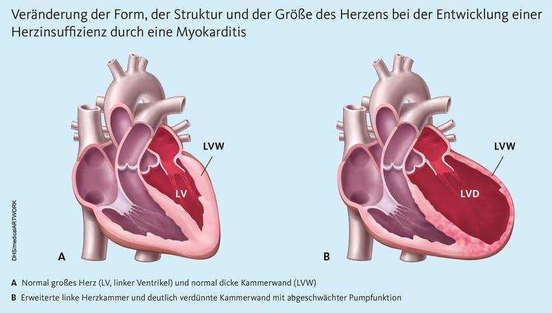 Veränderung der Form, der Struktur und der Größe des Herzens bei der Entwicklung einer Herzinsuffizienz durch eine Myokarditis. 